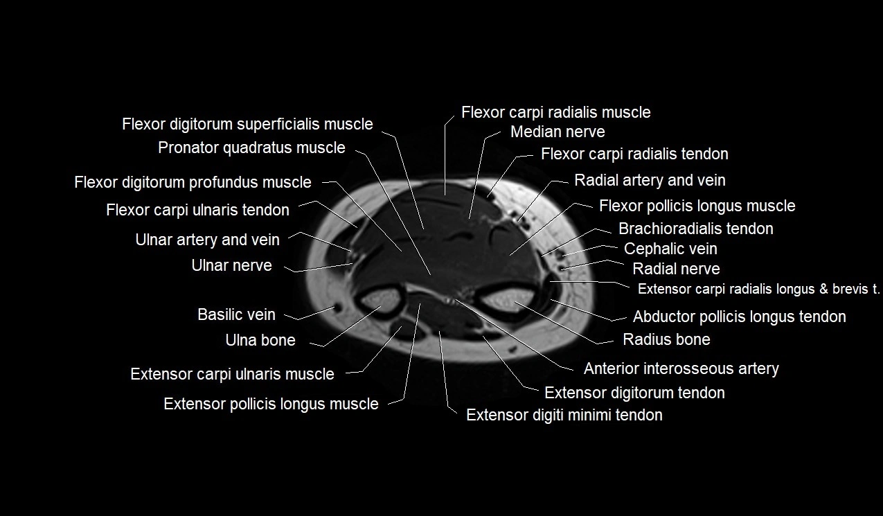 MRI 3T forearm axial cross sectional anatomy image 39.webp